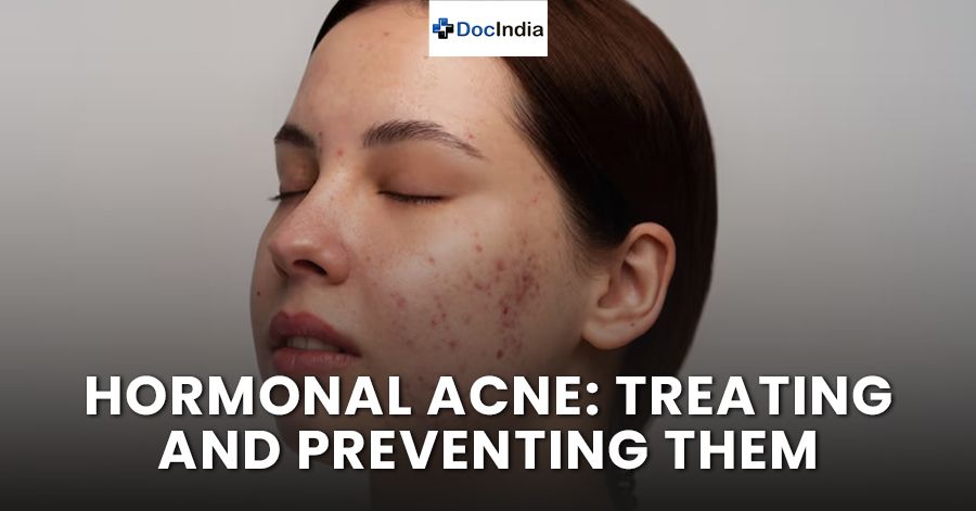 Hormonal acne: Treating and preventing them