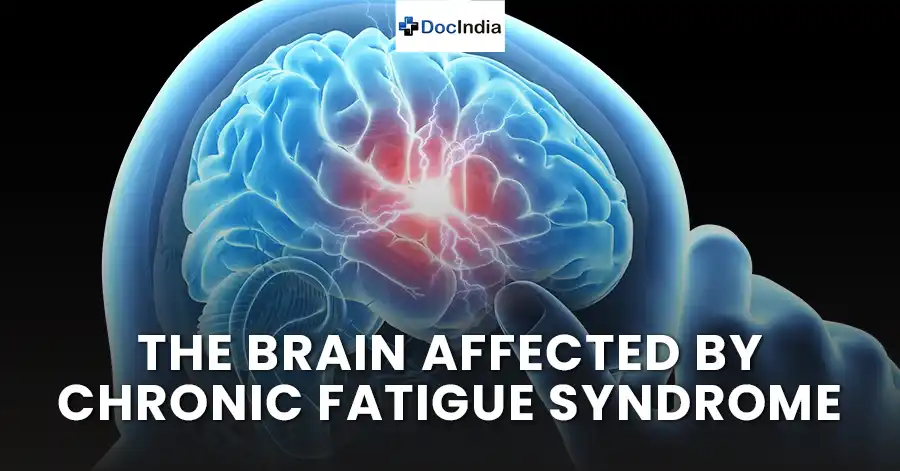 The brain affected by chronic fatigue syndrome