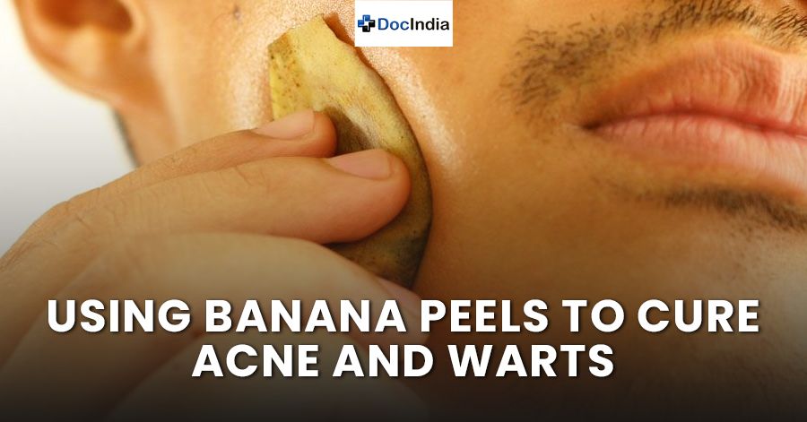 Using banana peels to cure acne and warts