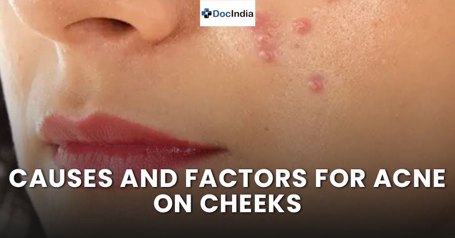 Causes and factors for acne on cheeks