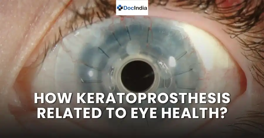 How keratoprosthesis related to eye health?