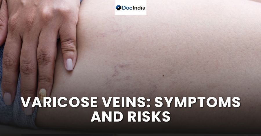 Varicose veins: Symptoms and risks