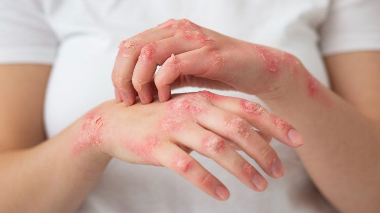 15 Ways to Get Relief from Hand Eczema