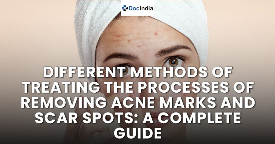 Different methods of treating the processes of removing acne marks and scar spots: a complete guide