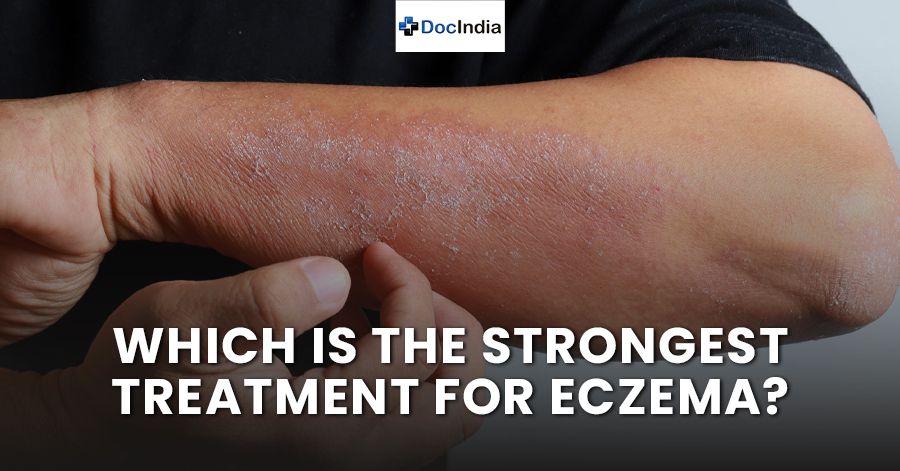 Which is the strongest treatment for eczema?