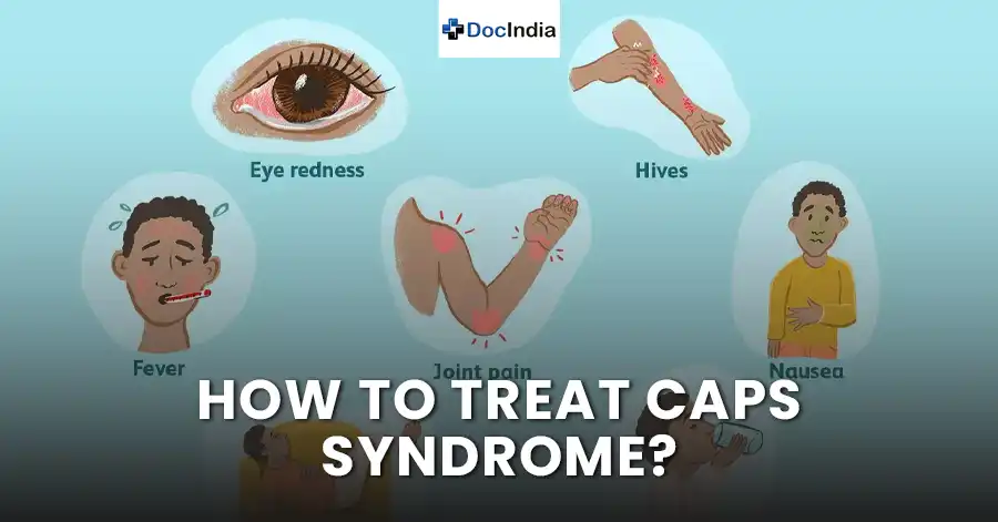 How to treat CAPS syndrome?