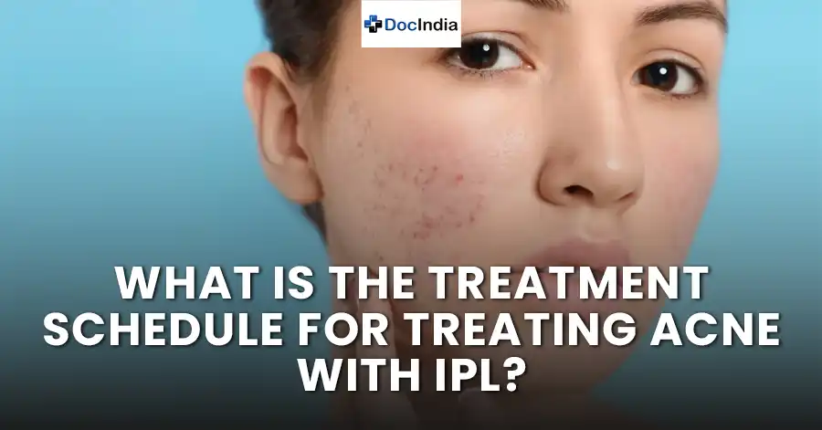 What is the treatment schedule for treating acne with IPL?