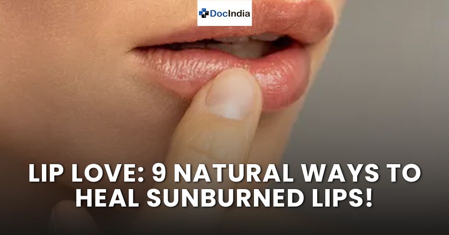 Lip Love: 9 Natural Ways to Heal Sunburned Lips!