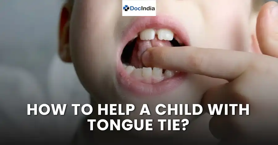How to help a child with tongue tie?