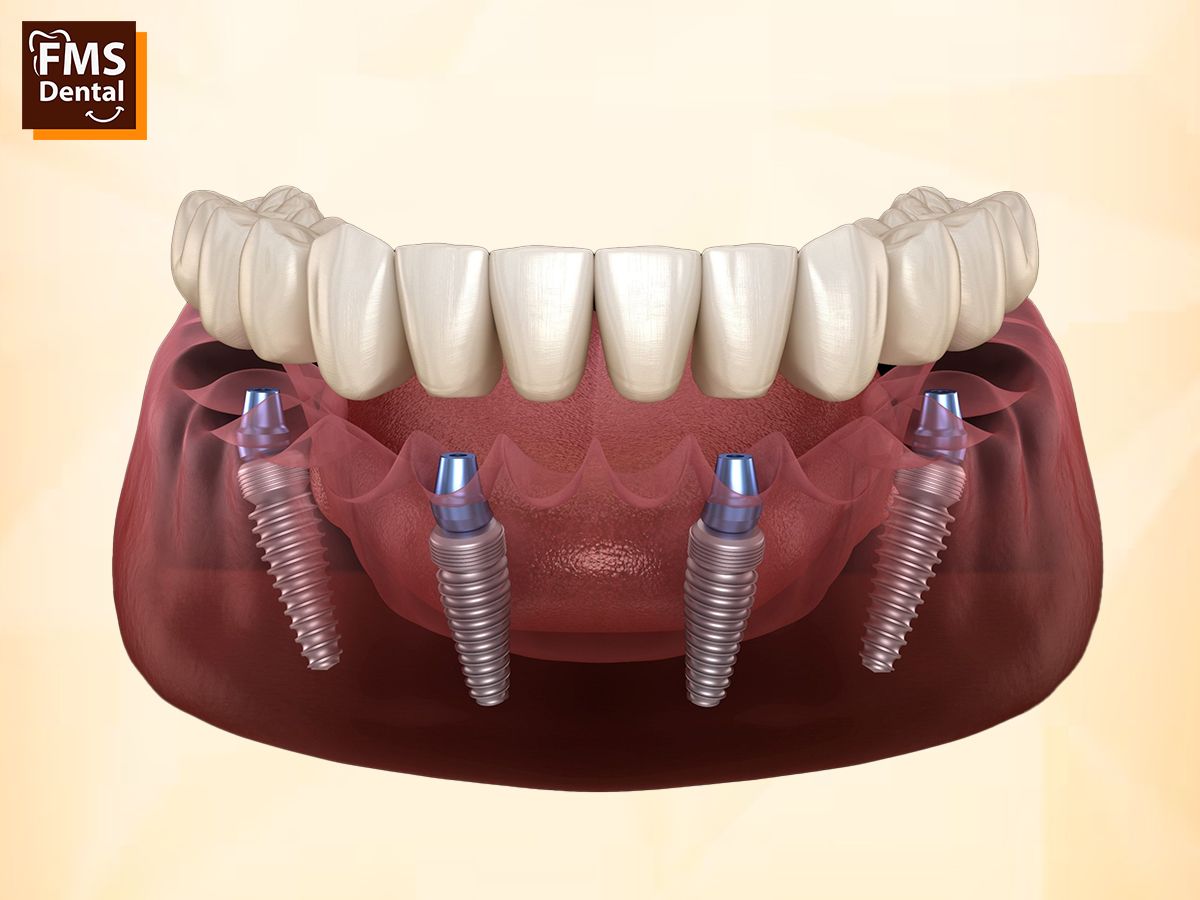 Planning for Dental Implants? Here Is the Complete Cost Breakdown You Need