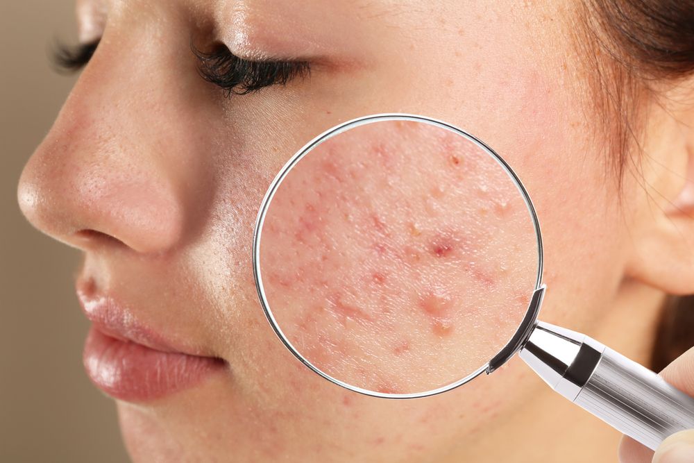 Acne-problem.jpg
