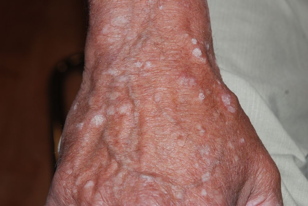 Actinic-keratosis.jpg