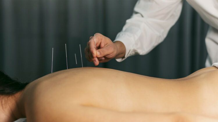 Acupuncture: Why it is Used, Benefits an