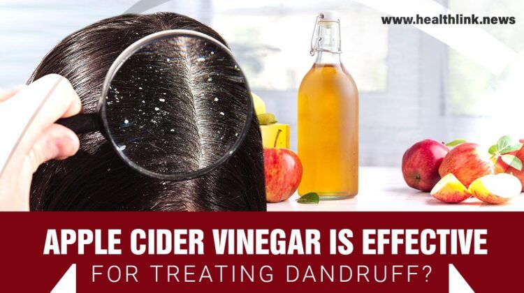 List of Natural Remedies for Dandruff 