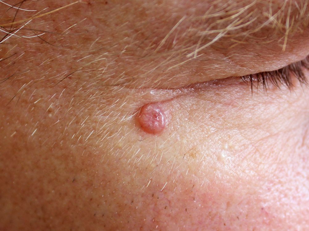 Basal-cell-carcinoma.jpg