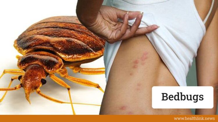 Bedbug Bites: Symptoms, Treatment & Prevention | Docindia.org