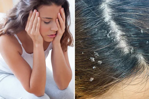 Best Herbal Hair Oils for Dandruff Relief in 2025 | Docindia.org