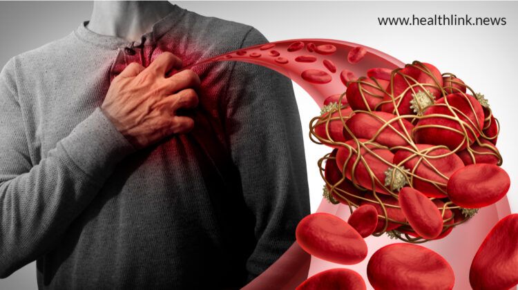 Blood Clotting Symptoms Should not be Neglected: Be Careful!