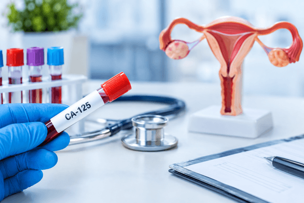CA125 Test: What It Detects, Who Needs It and What the Results Mean
