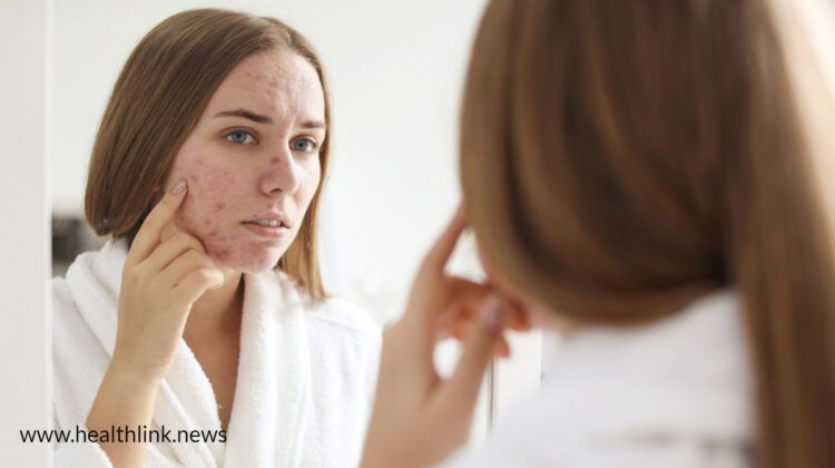 Why does acne come out on the face and how to treat it?