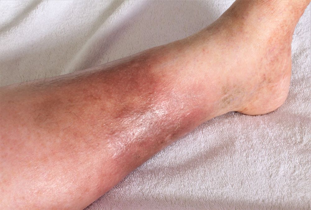 Cellulitis.jpg