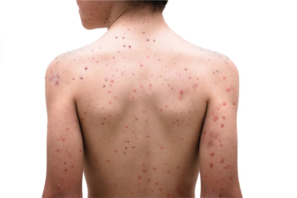 Chickenpox.jpg