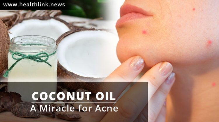 Coconut Oil for Acne: How to Use and How it Works?