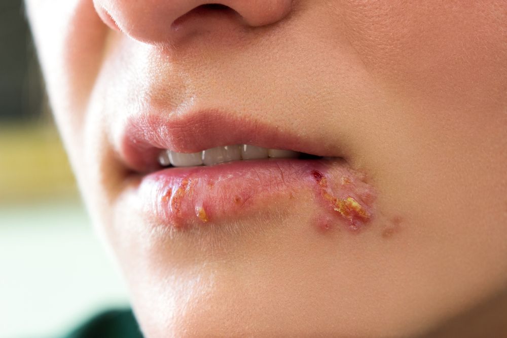 Cold-sore.jpg