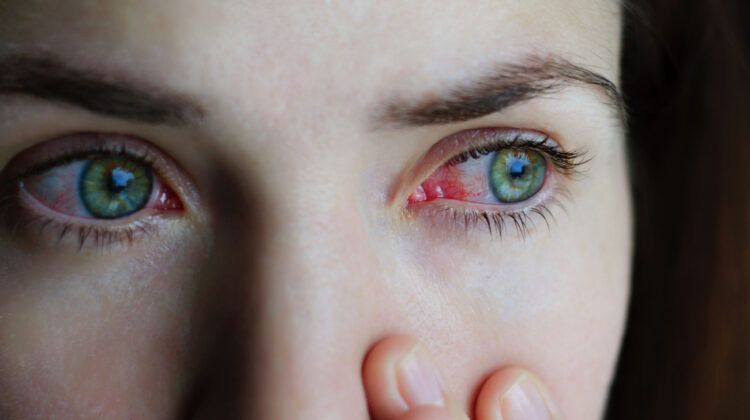 Conjunctivitis: Symptoms, Causes, Diagnosis and Treatments