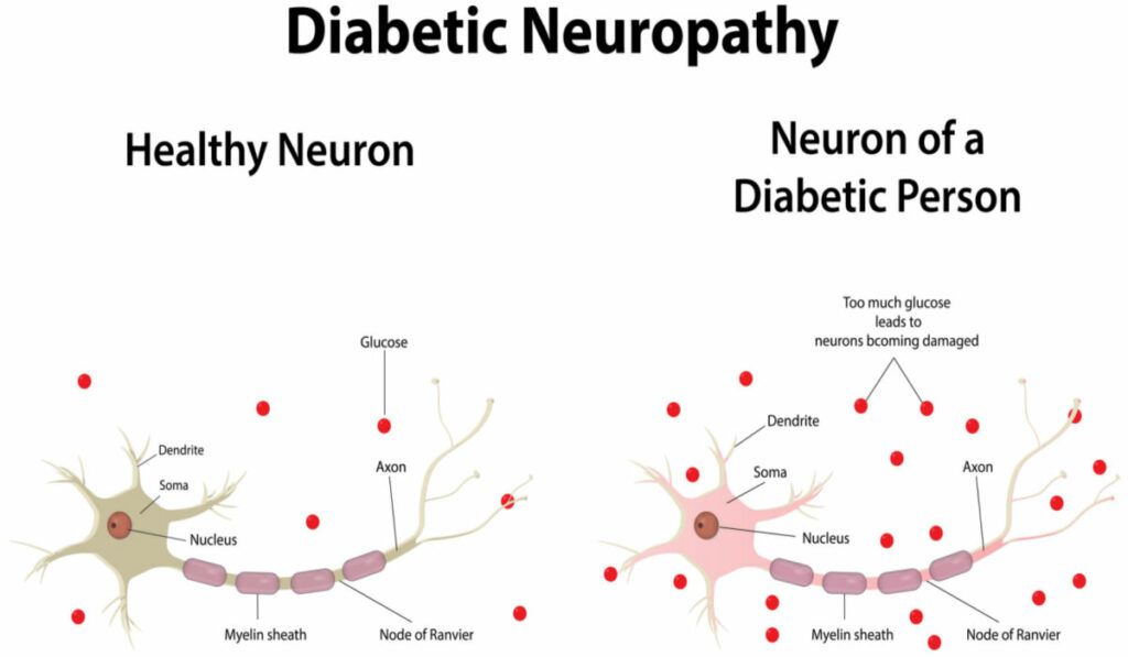 Diabetic-Neuropathy-1024x597.jpg