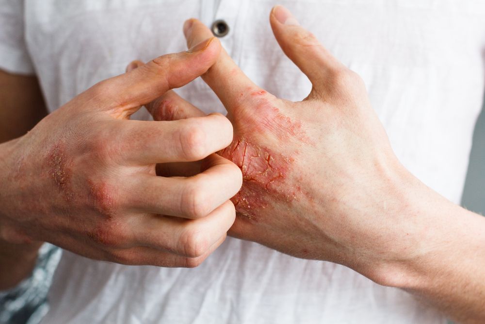 Eczema.jpg