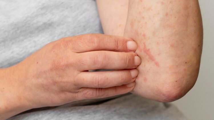 Eczema And Inflammation: How to Cure it Permanently?