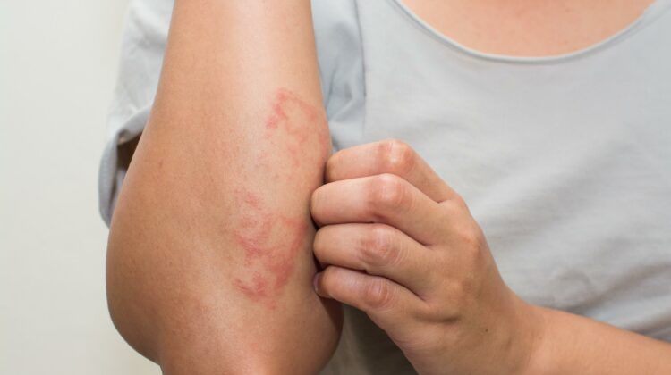 Eczema: Symptoms, Causes, Effects, and Its Prevention