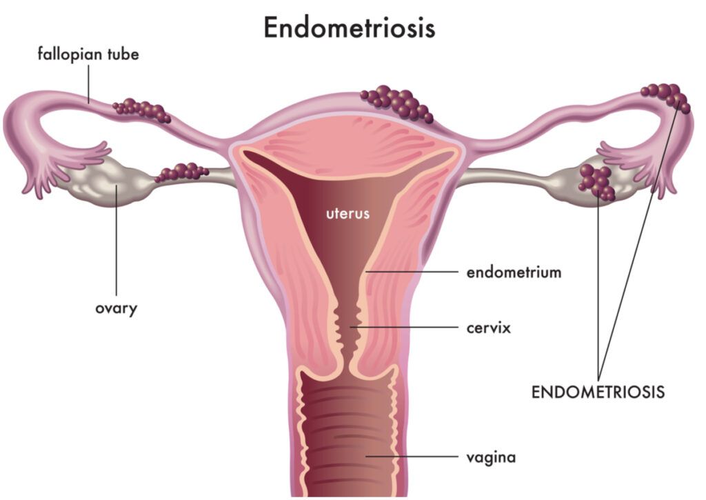 Endometriosis-1024x725.jpg