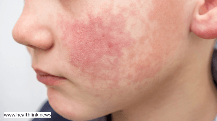 Fifth Disease in Children: How Long Does This Infection Last?