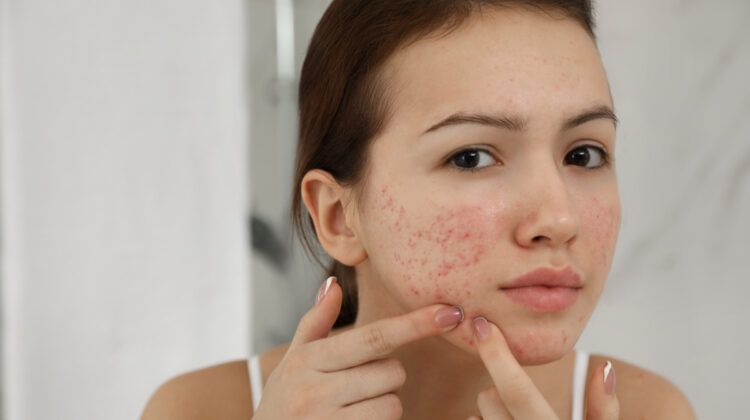 Foods that Causes Acne and Why?