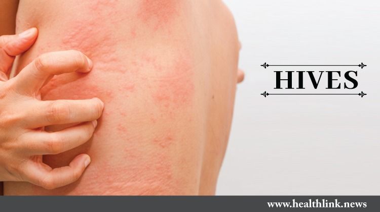 Hives – Causes, Diagnosis, and Treatments