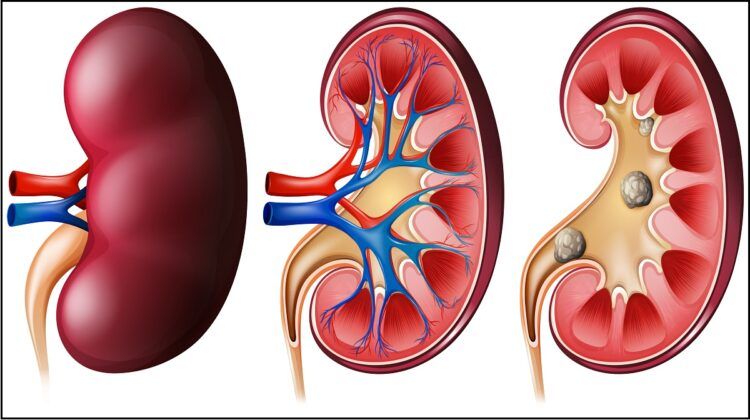 Home Remedies That Can Help to Treat Kidney Stones