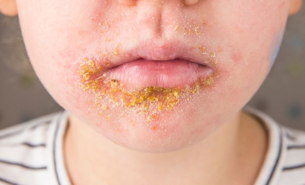 Impetigo.jpg