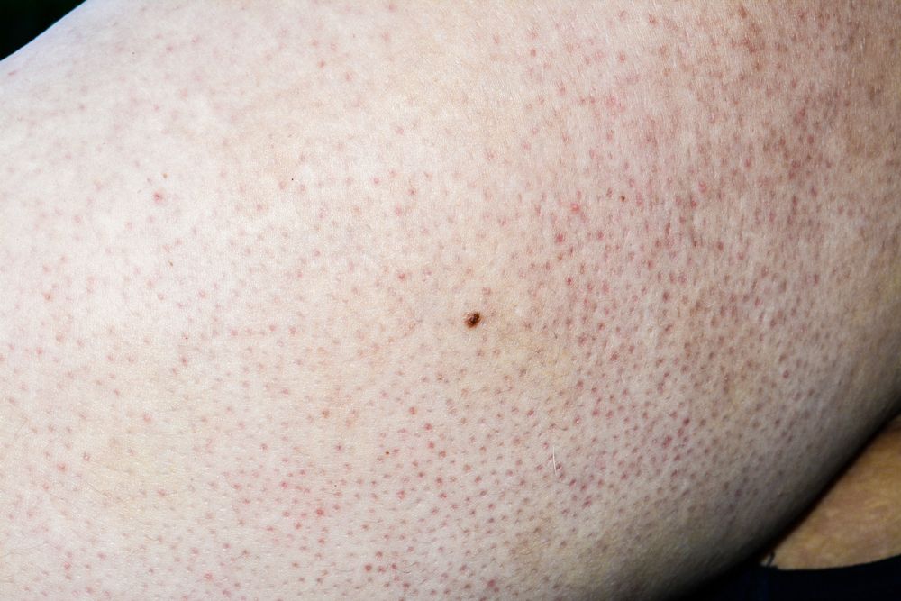 Keratosis-pilaris.jpg