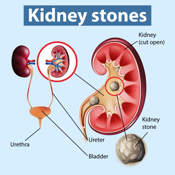 Kidney-Stone-600x600.jpg