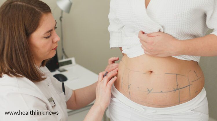 Liposuction: How Much is Safe and Who Should Avoid the Surgery?