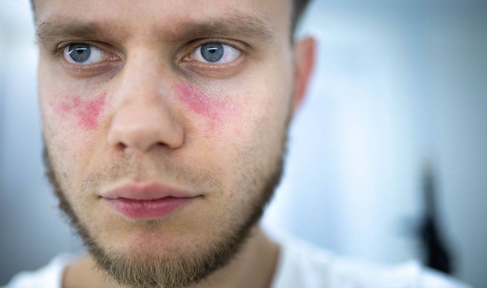 Lupus.jpg