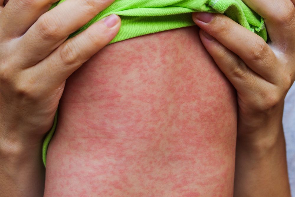 Measles.jpg
