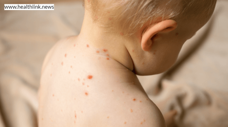 Why You Should Care About Measles in Children?