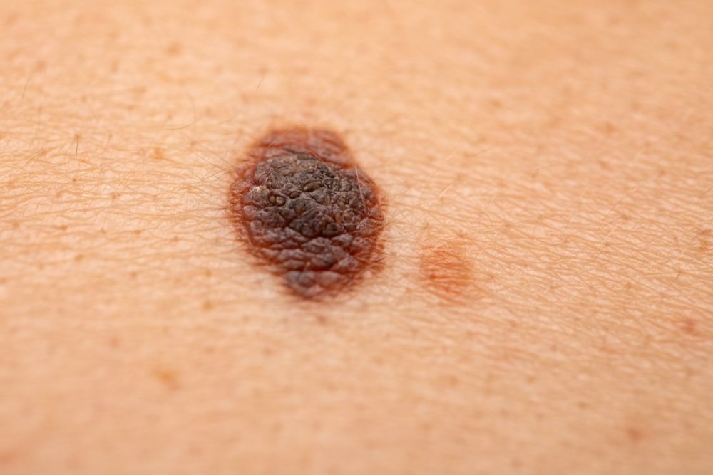 Melanoma.jpg