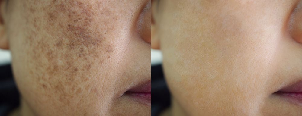 Melasma.jpg