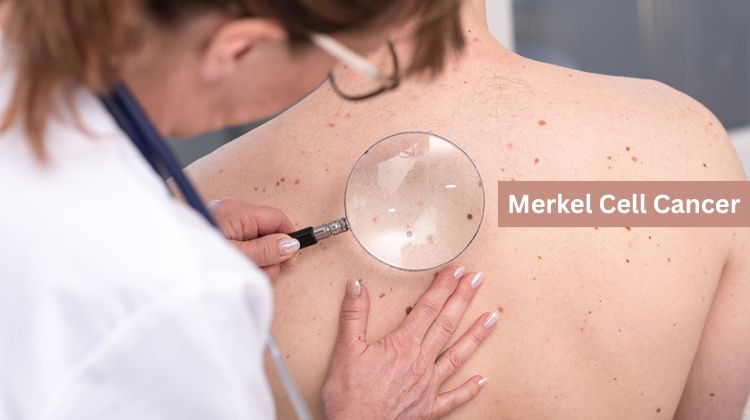 Merkel Cell Cancer: Symptoms, Causes and Complications