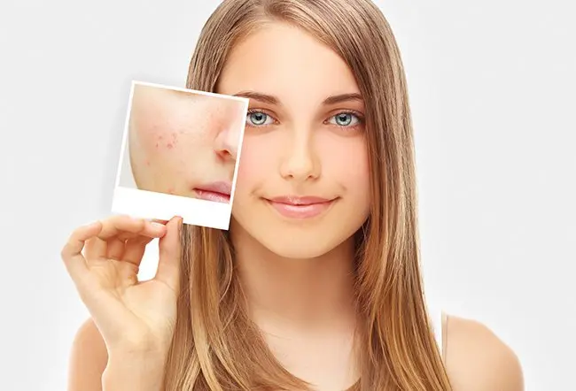 Natural Remedies for Acne: Effective Home Treatments | DocIndia.org
