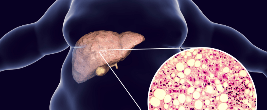 Non-Alcoholic Fatty Liver Disease (NAFLD) | DocIndia.org